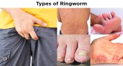 Types of Ringworm